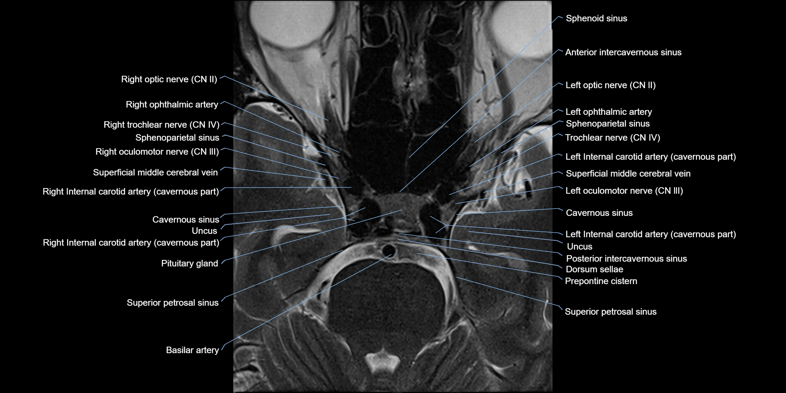 MRI cavernous sinus axial cross sectional 3T anatomy image-img-11001-00011.webp